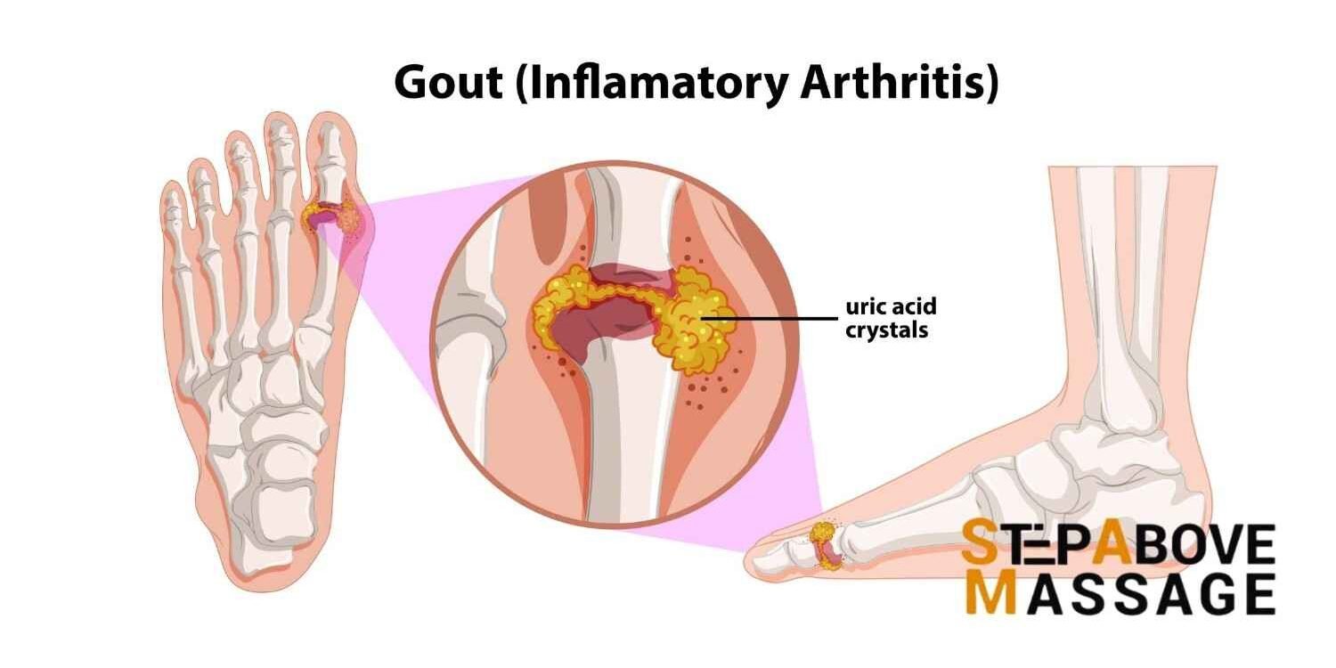 massage gout