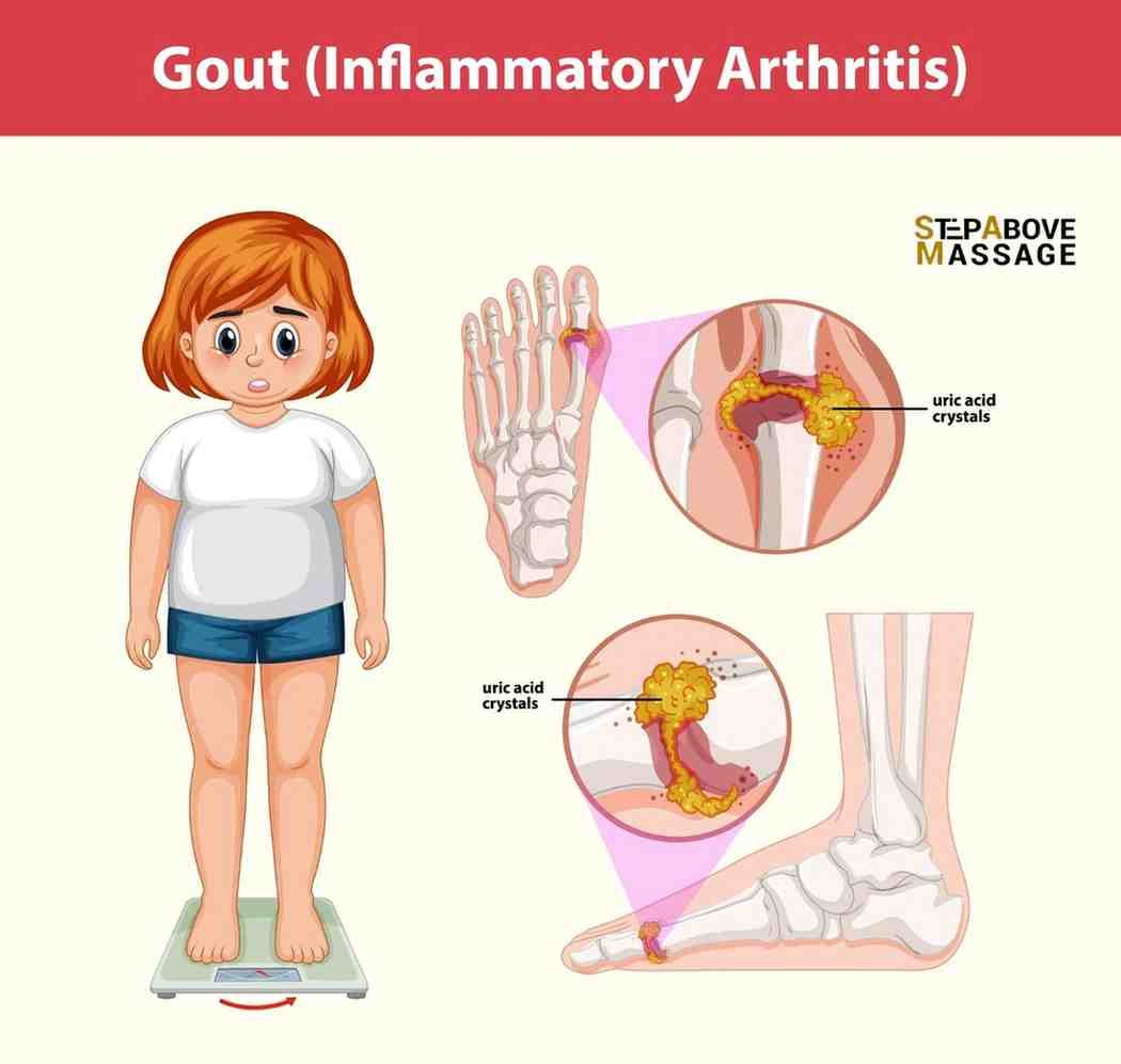 Massage Therapist Need to know about Gout