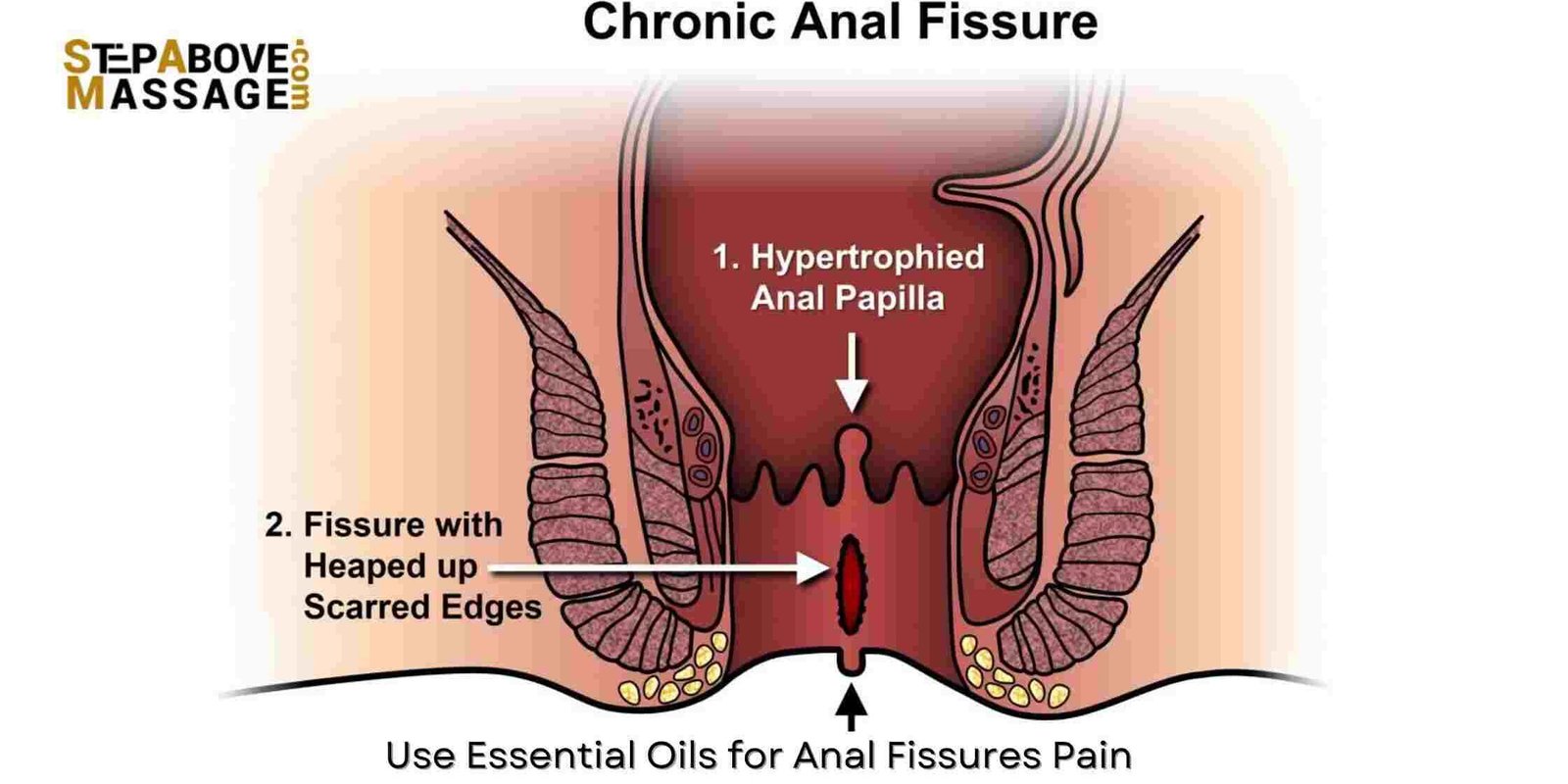 Essential Oils for Anal Fissures Essential Oils for Anal Fissures