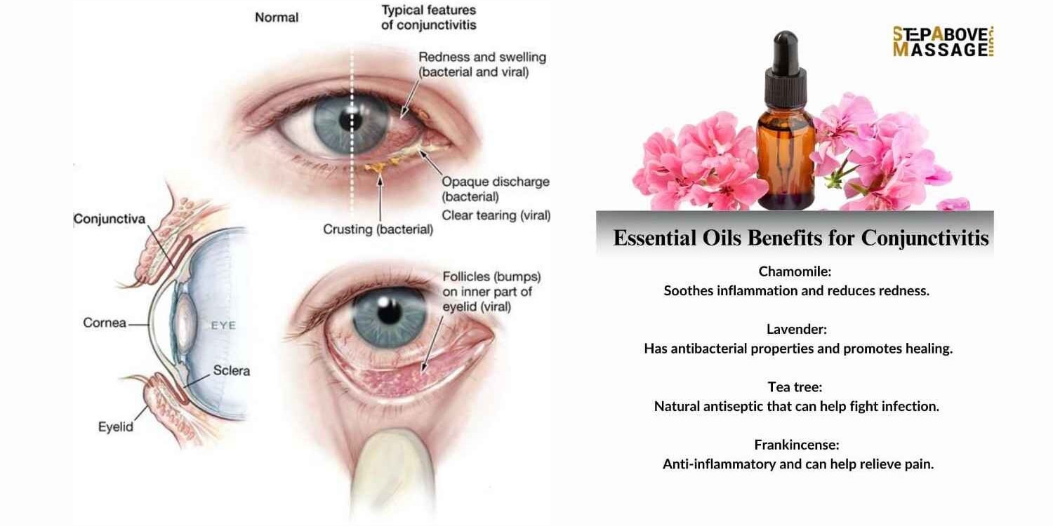Essential Oils for Conjunctivitis