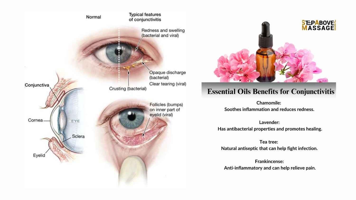 Essential Oils for Conjunctivitis