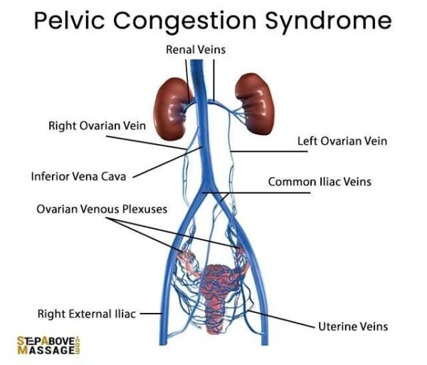 Massage for Pelvic Pain or Pelvic Venous Congestion Syndrome (PVCS